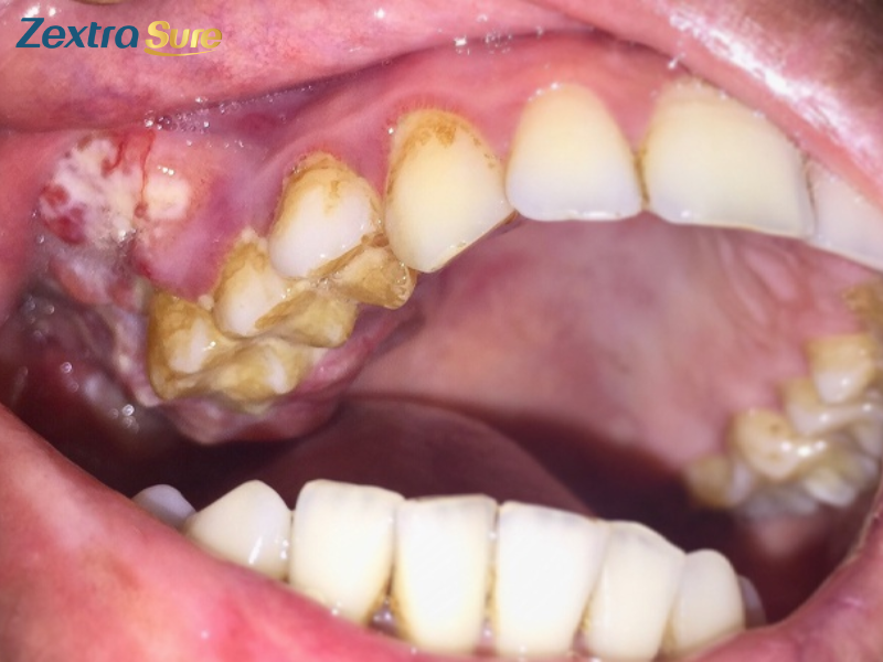 jaw-cancer-symptoms (3)